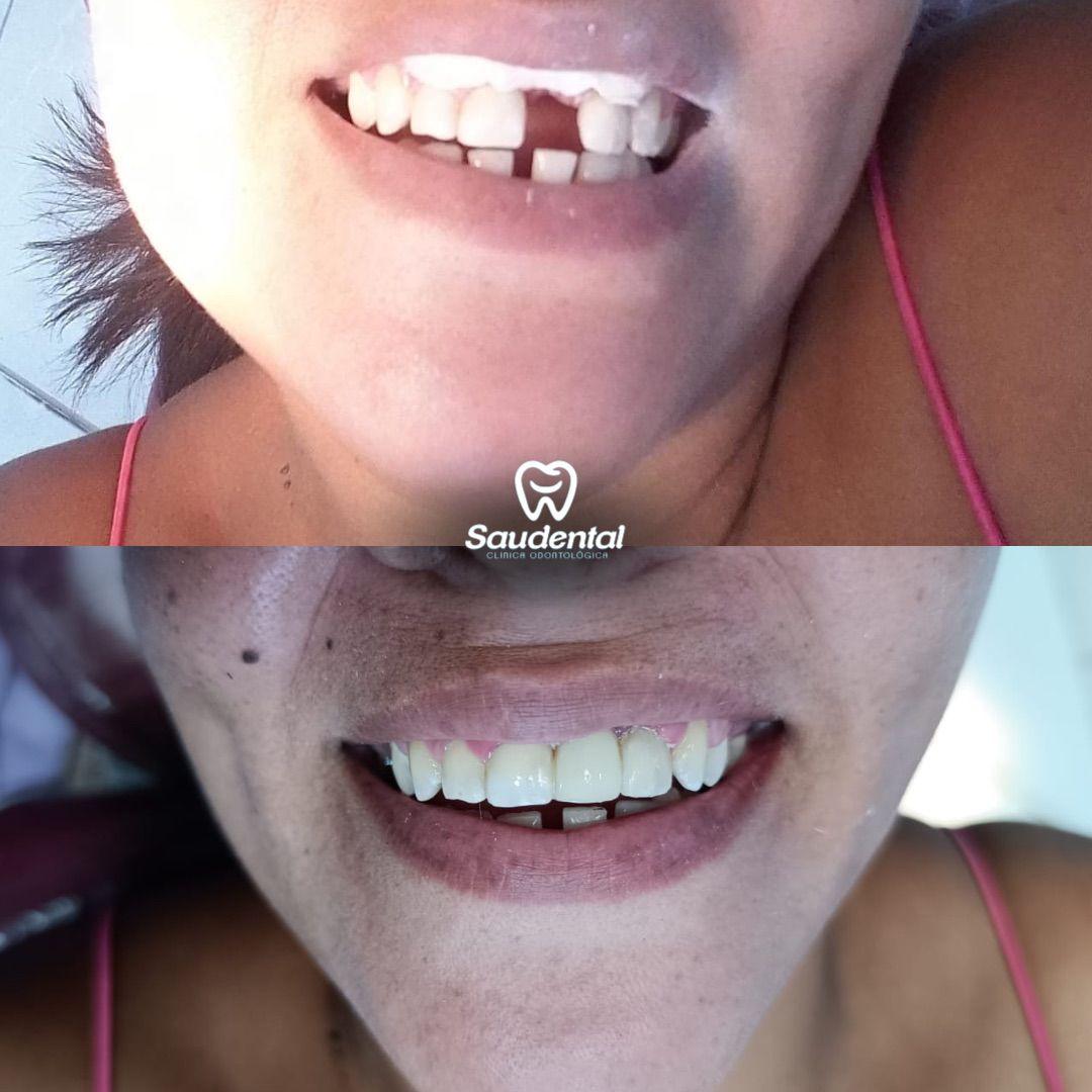 Saudental Paulista. Prótese Dentária #1.1