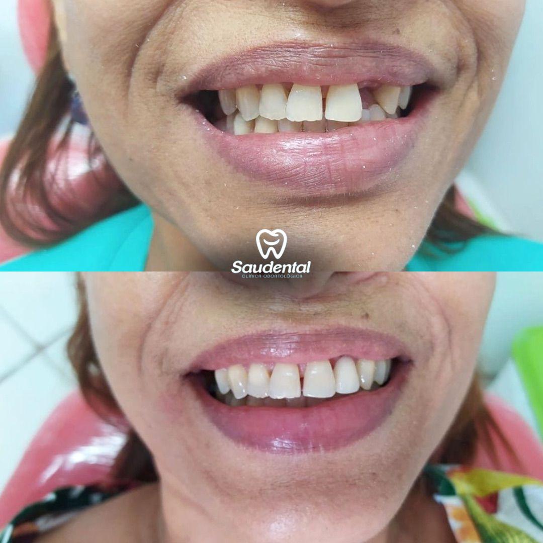 Saudental Paulista. Prótese Dentária #2.1