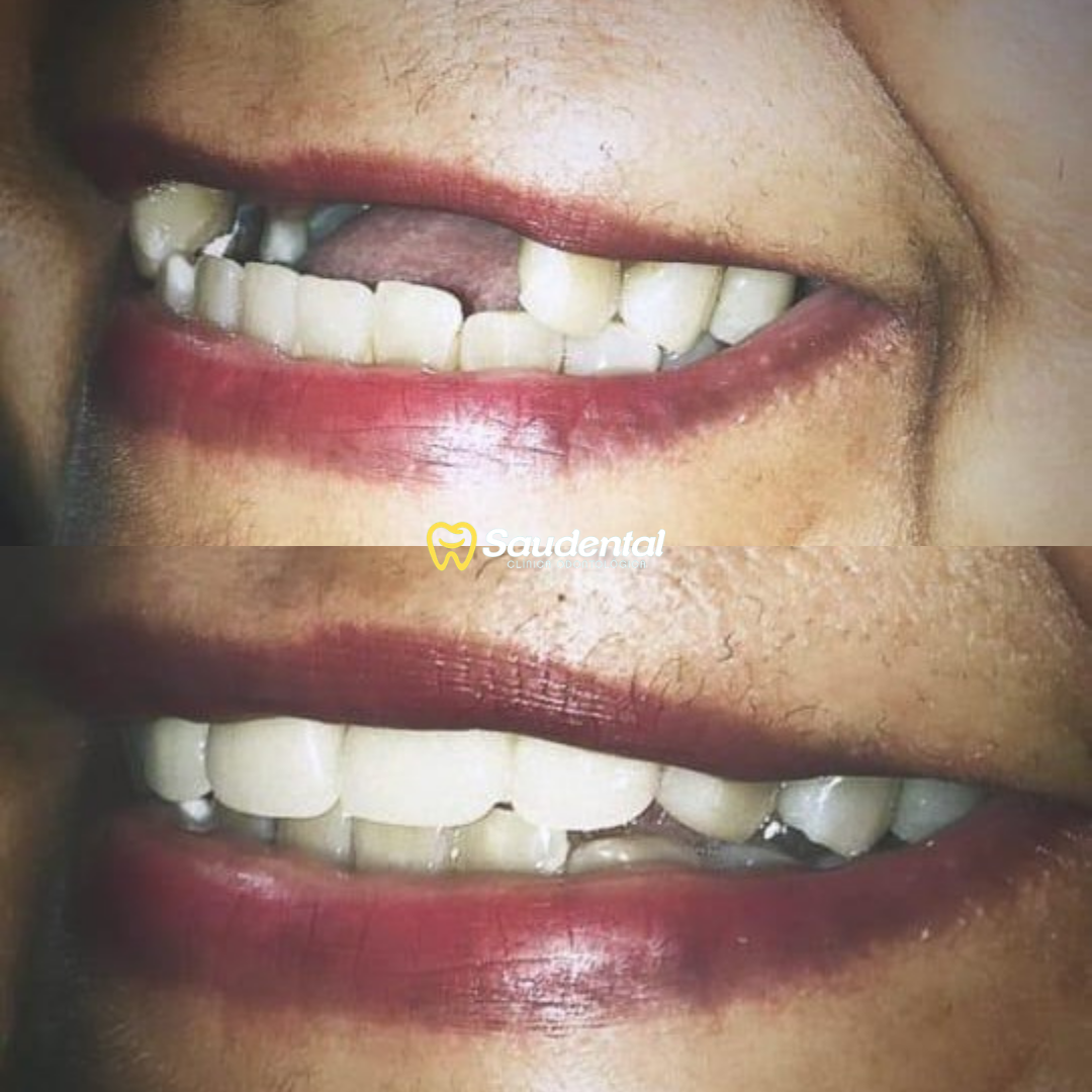 Saudental Paulista. Prótese Dentária #3.2