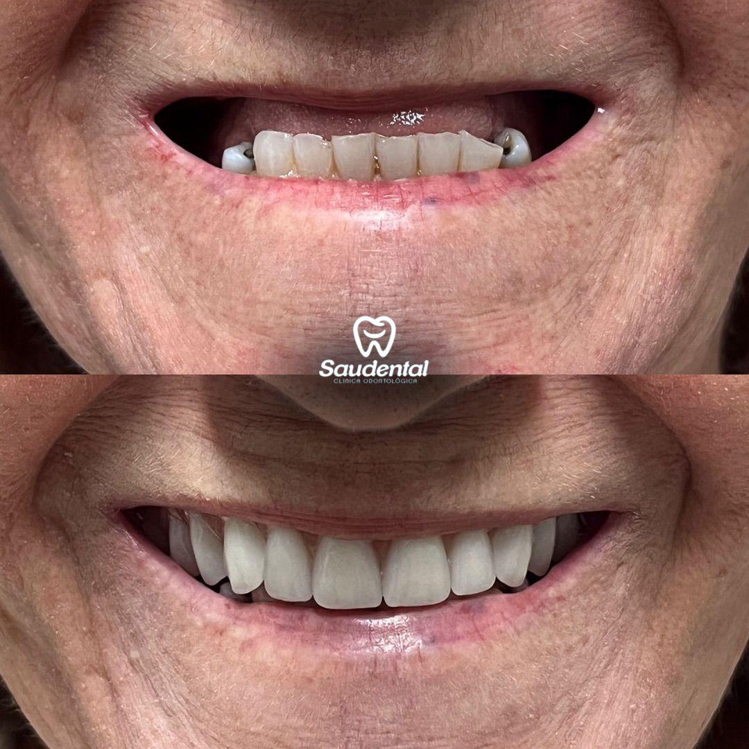 Saudental Paulista. Prótese Dentária #5.1