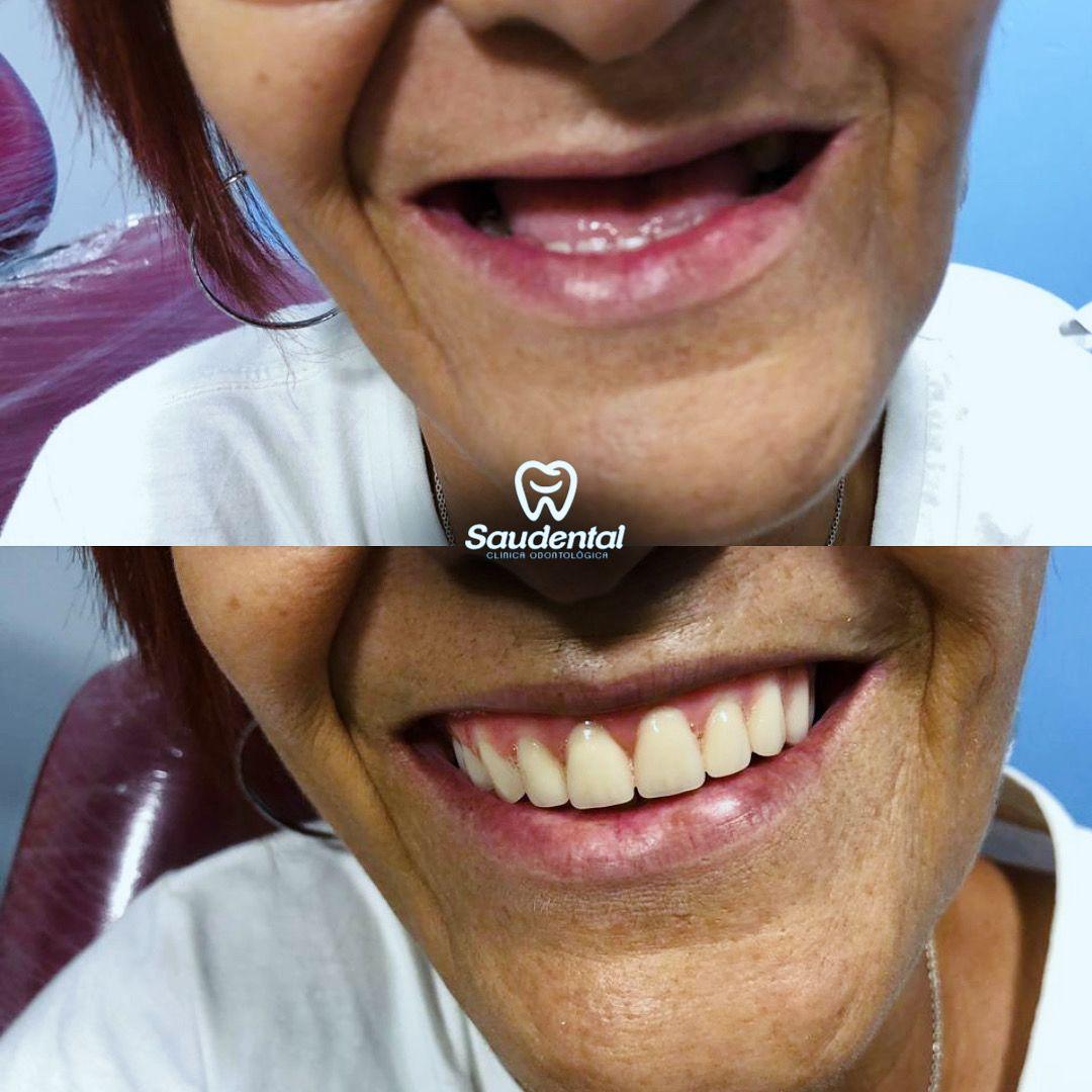 Saudental Paulista. Prótese Dentária #6.1