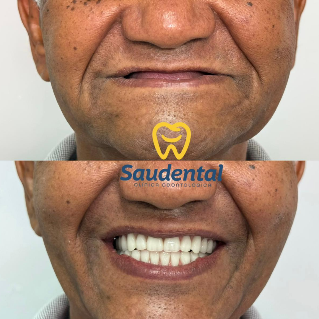 Saudental Paulista. Prótese Dentária #7.2